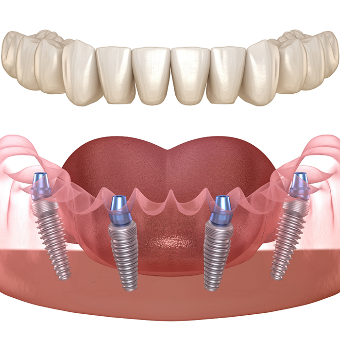 Illustration of a full denture being placed over four dental implants