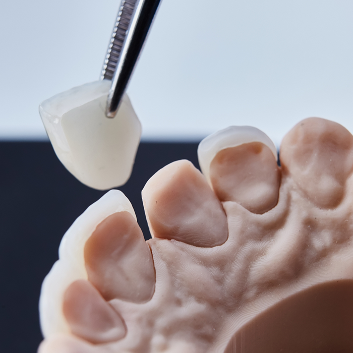 Tweezers placing a veneer over a model of a tooth