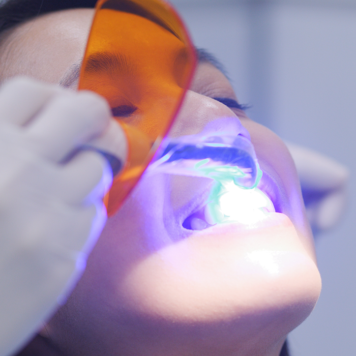 Dental patient having an ultraviolet light shone onto their tooth