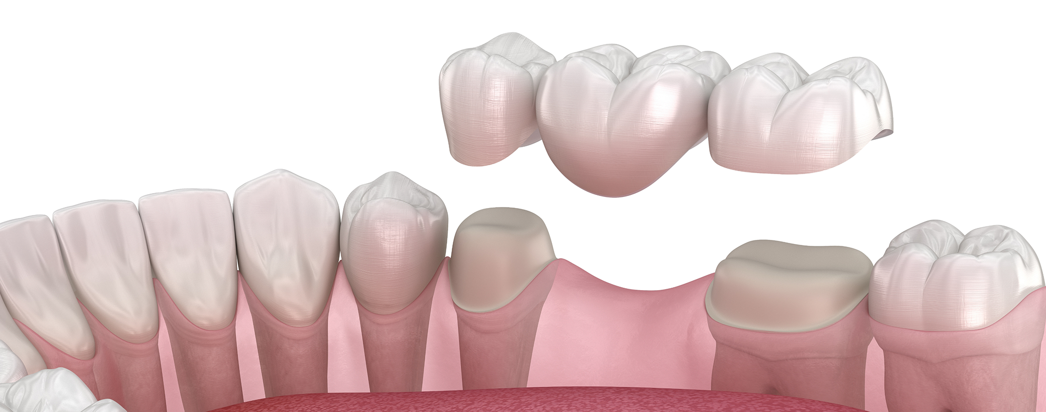 Illustration of a dental bridge in Sterling Heights replacing a missing tooth
