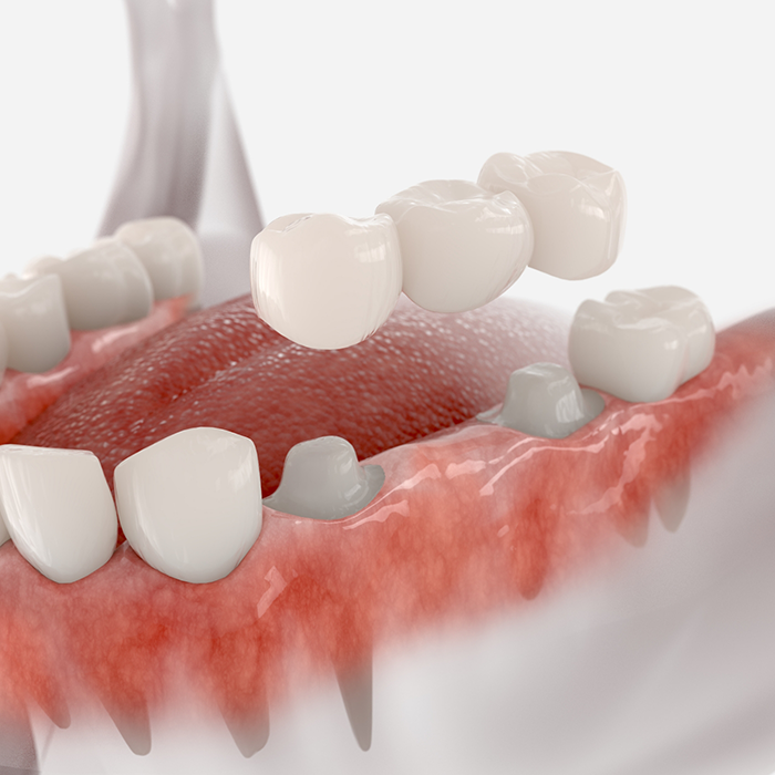 Illustrated dental bridge replacing a missing tooth