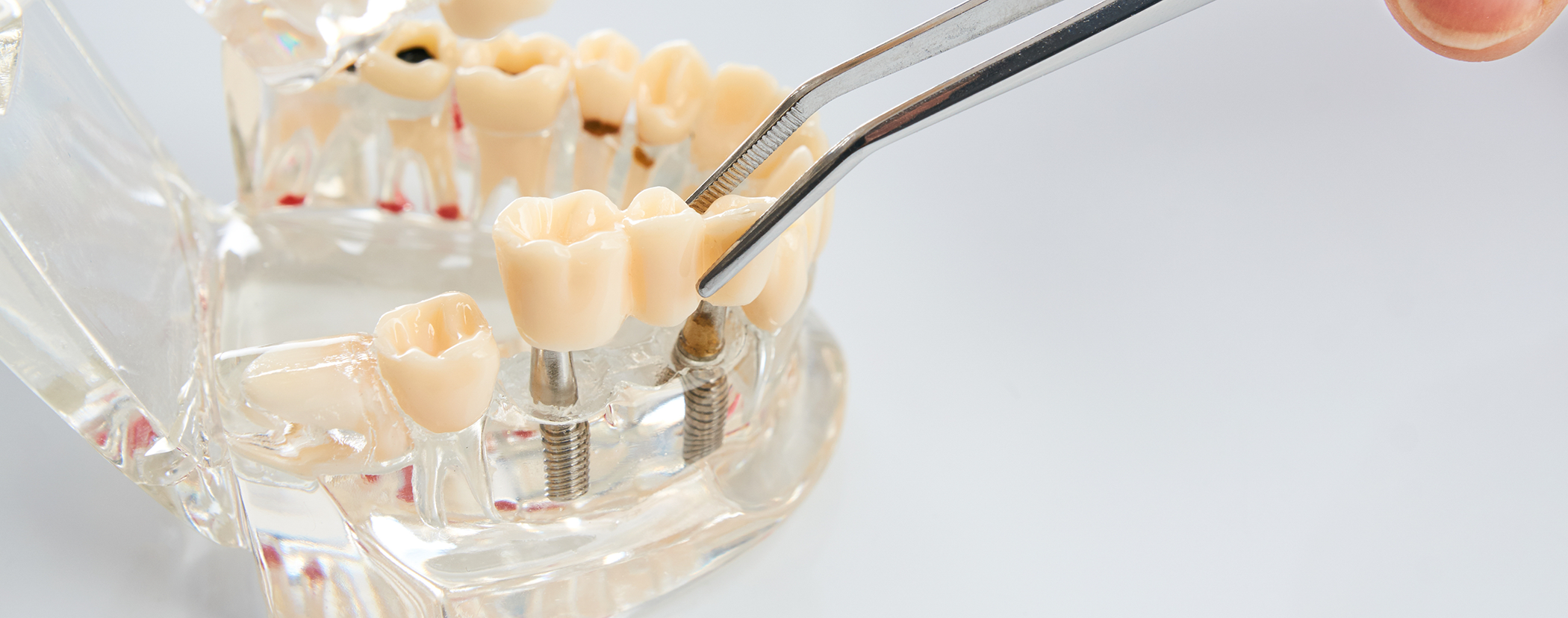 Model of a mouth with two dental implants in Sterling Heights replacing three missing teeth