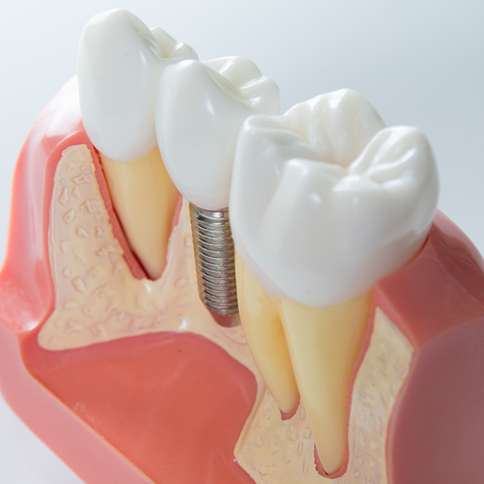 Model of a dental implant replacing a missing tooth