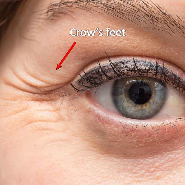 Close up of crow's feet next to a person's eye