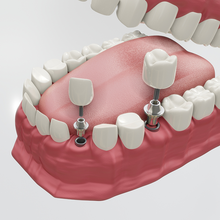 Illustration of two dental implants replacing two missing teeth