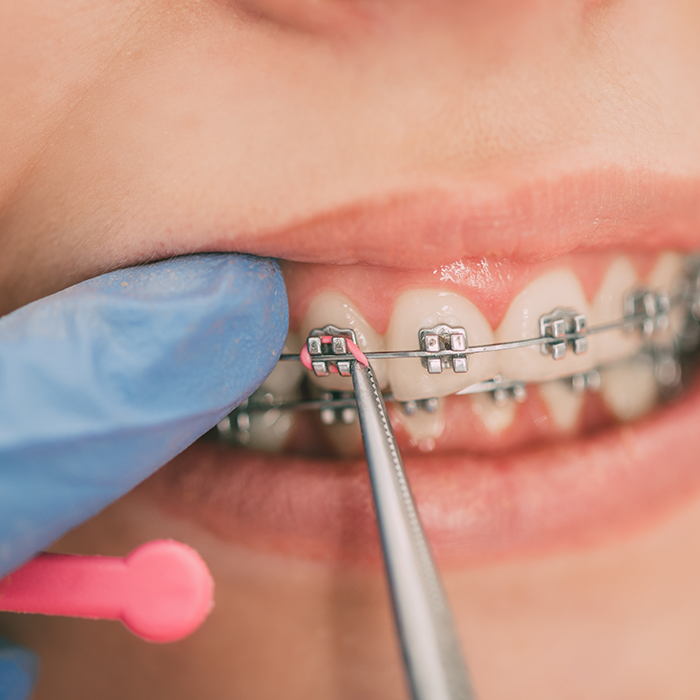 Close up of elastic bands being placed over braces brackets