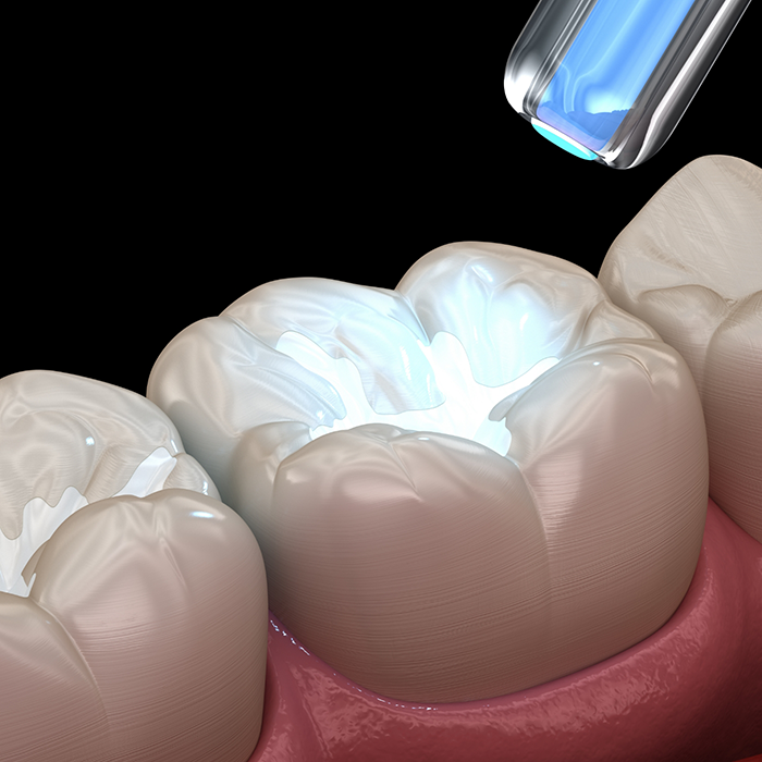 Illustration of a dental sealant being applied to a tooth