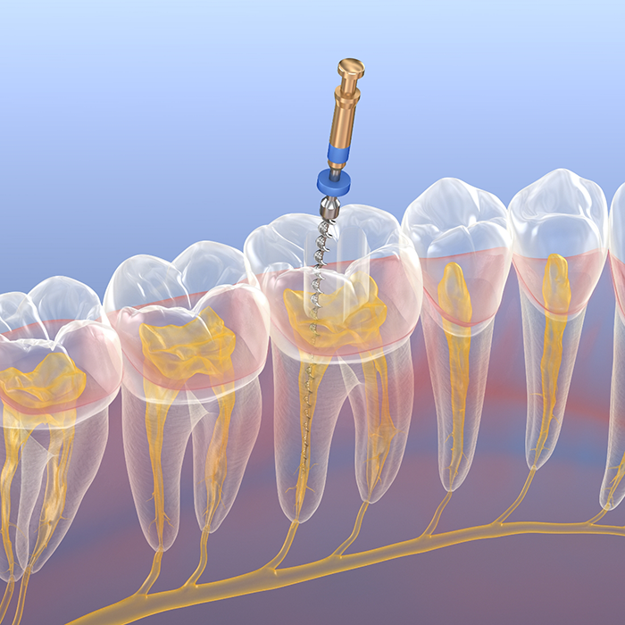 Illustration of a thin dental instrument treating the inside of a tooth