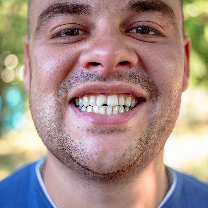 Man smiling with a chipped tooth