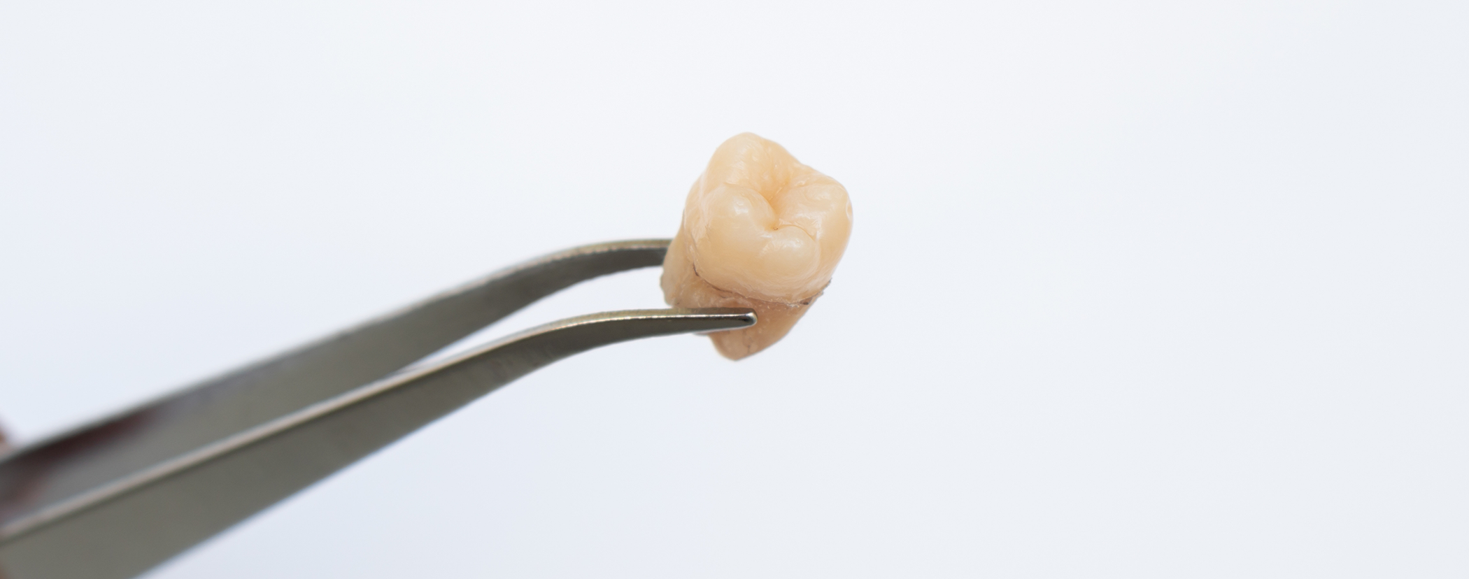Tweezers holding an extracted tooth
