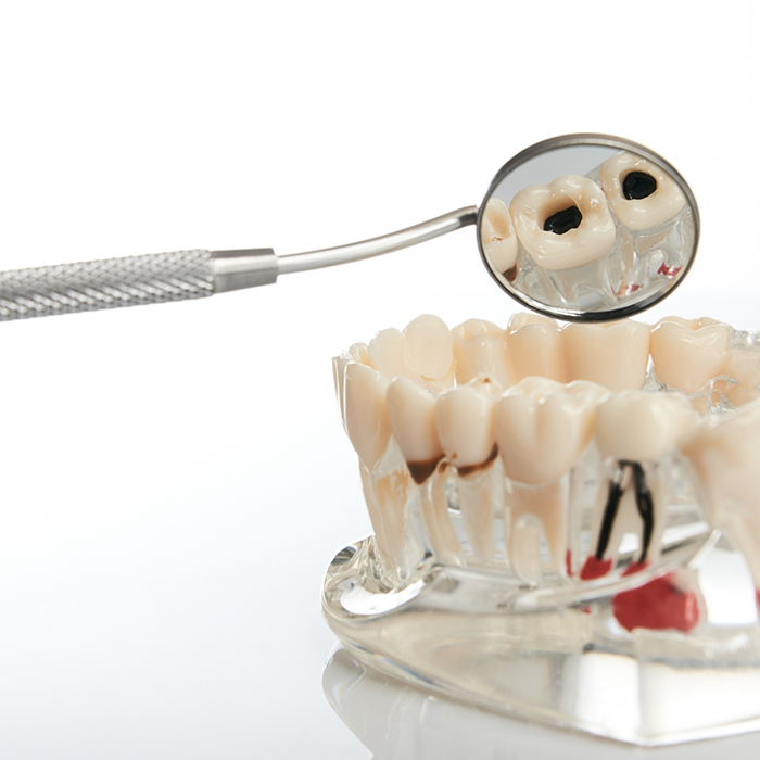 Model of the teeth with a few severely decayed and damaged teeth