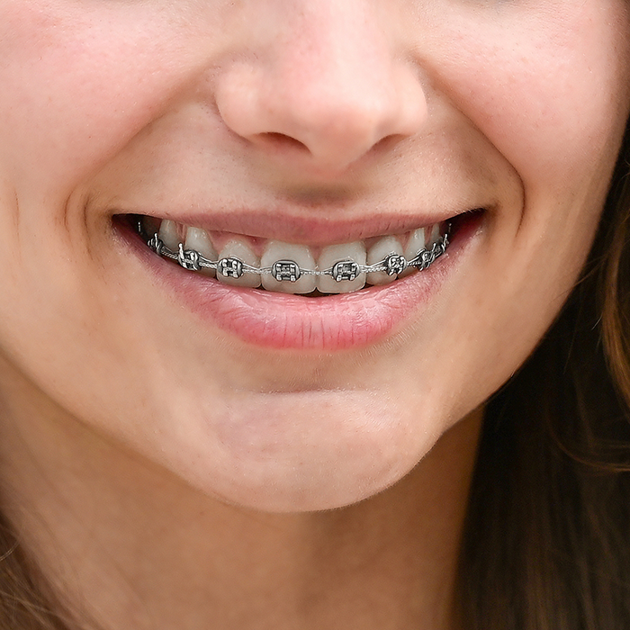 Close up of a smile with traditional braces