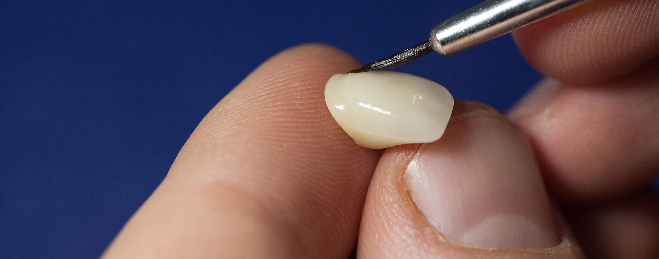Dentist placing adhesive material onto a veneer